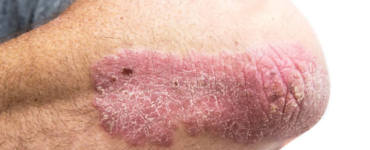 HOW TO EXAMINE YOUR SKIN FOR CANCER