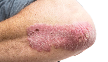 HOW TO EXAMINE YOUR SKIN FOR CANCER