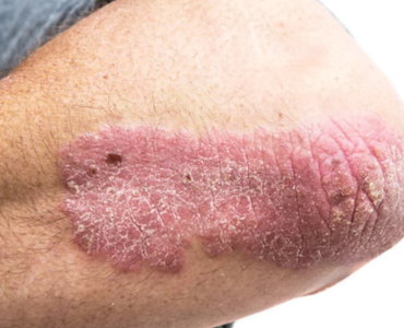 HOW TO EXAMINE YOUR SKIN FOR CANCER